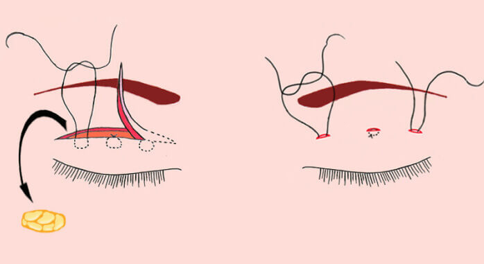 Double Eyelid Surgery
