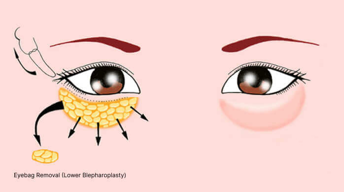 Eyebag Removal Surgery